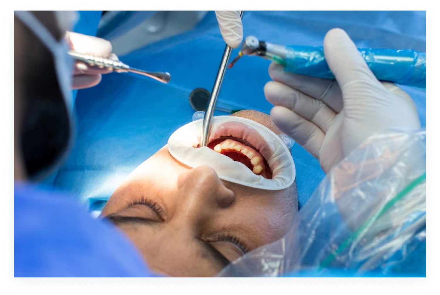 Cirugía Dental en Cehegín