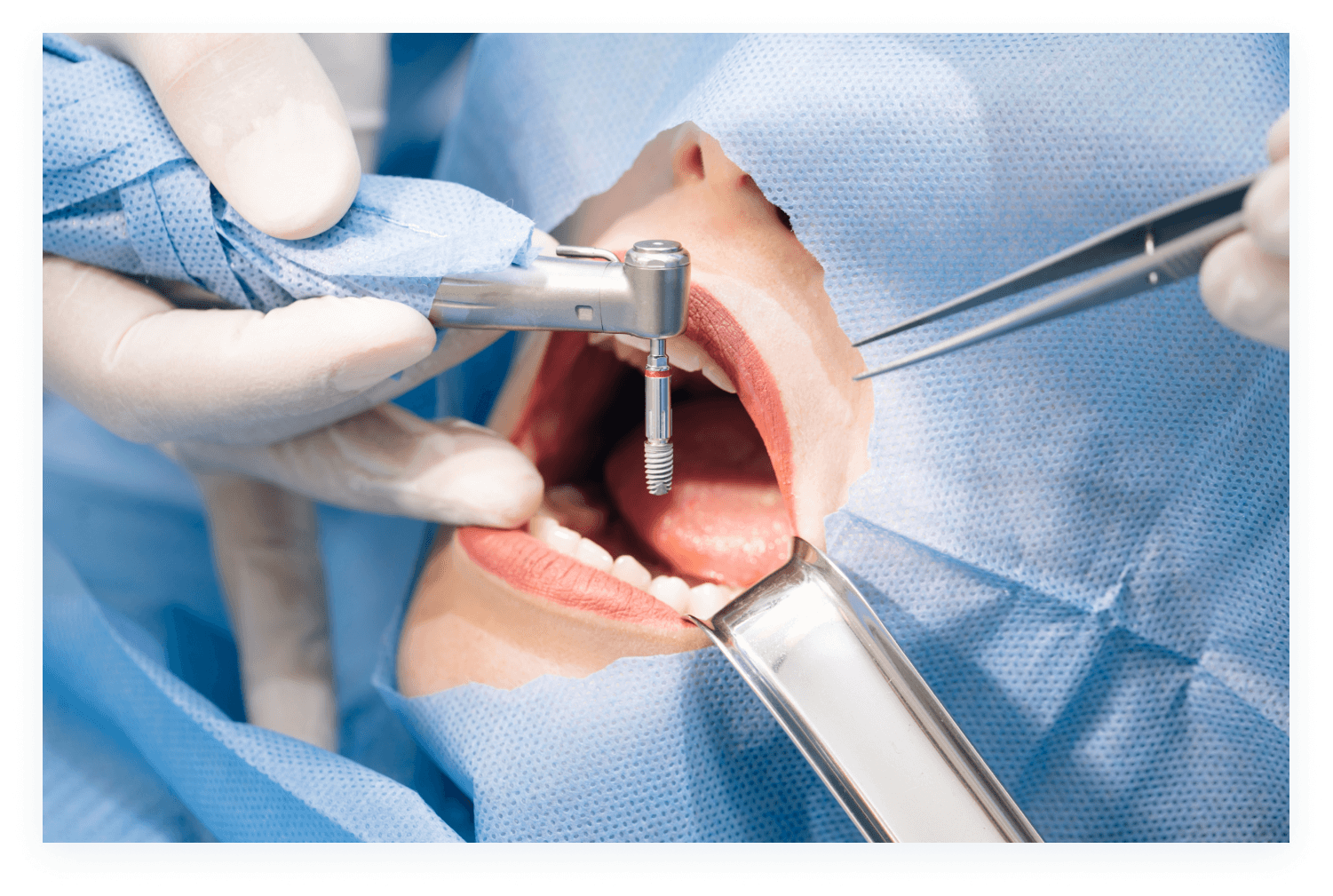 Qué es la Cirugía Periodonta