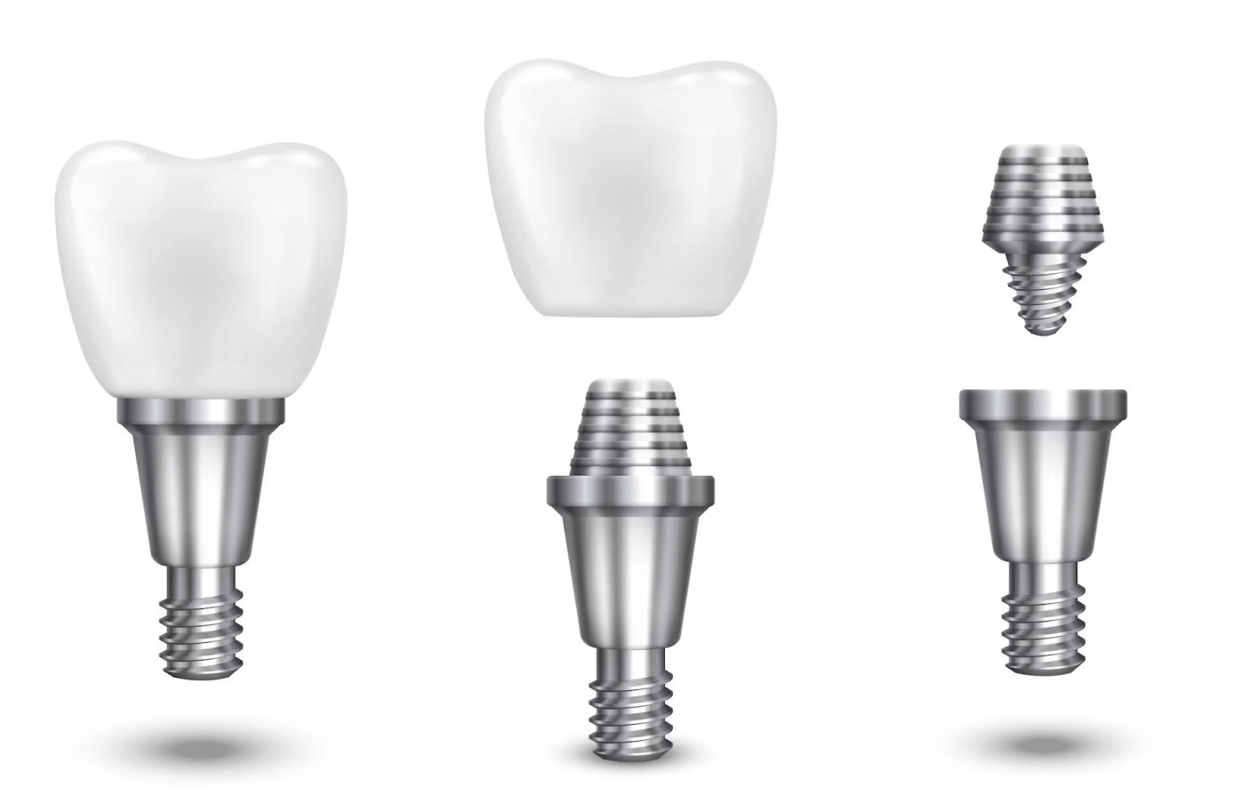 Qué son los Implantes Dentales